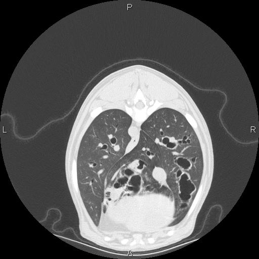CT scan Bronchiectasis0003