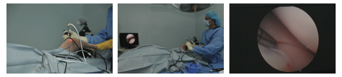 Arthroscopy With Canine Cranial Cruciate Ligament Disease